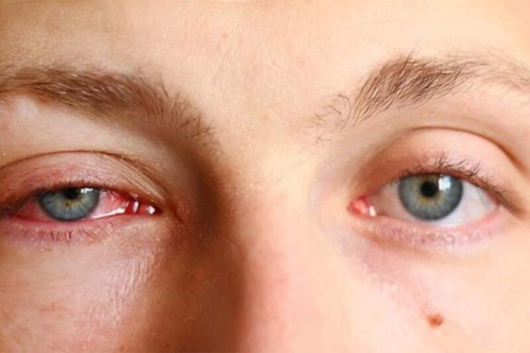   Cắt mí hỏng chính là nguyên nhân dẫn tới tổn thương tuyến lệ