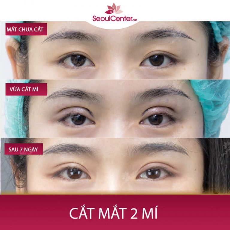   Cắt mí tại địa chỉ thẩm mỹ uy tín, chất lượng sẽ ngăn ngừa tối đa các tổn thương tới tuyến lệ