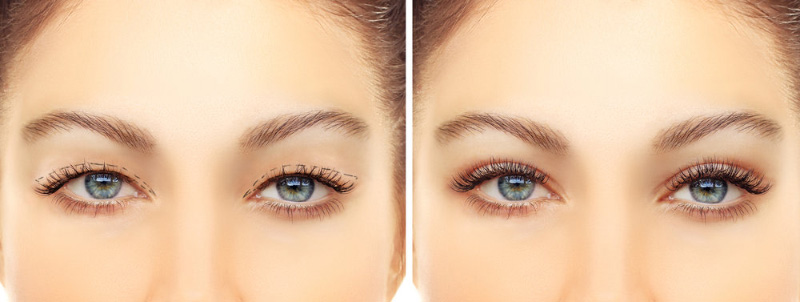 Nhấn mí laser cho hiệu quả nhanh chóng, không cần nhiều thời gian nghỉ dưỡng