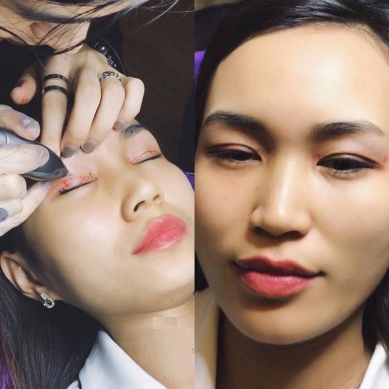 Bác sĩ cần thao tác chuẩn xác đề tạo mí mắt sâu, sắc nét