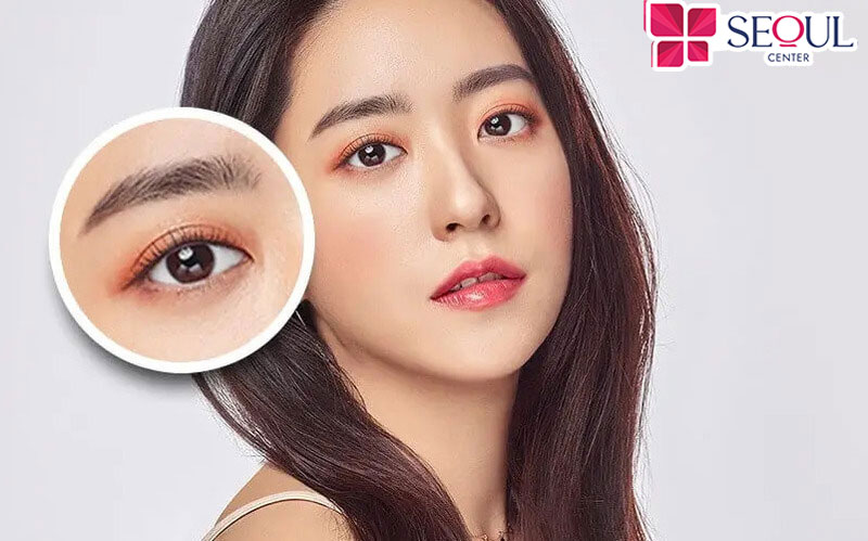   Phương pháp nhấn mí mắt Hàn Quốc mang đến dáng mắt cân đối