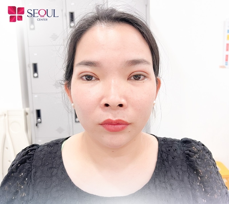 Phần lớn khuyết điểm như mỡ thừa, da dư đều được xử lý triệt để