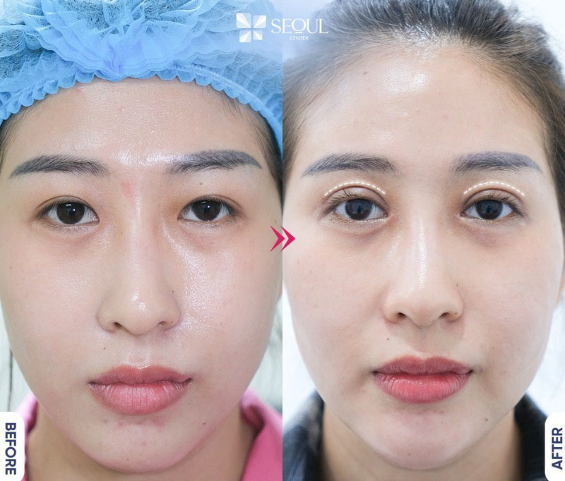 Mở rộng góc mắt cho bạn vẻ đẹp cân đối, thu hút hơn