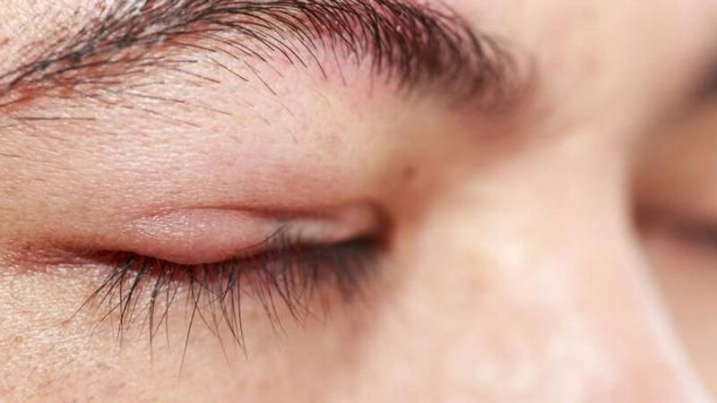 Mí mắt đau sưng lâu ngày, tác động tiêu cực đến thị lực