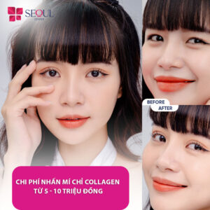 Giá nhấn mí Collagen dao động từ 5 – 10 triệu đồng