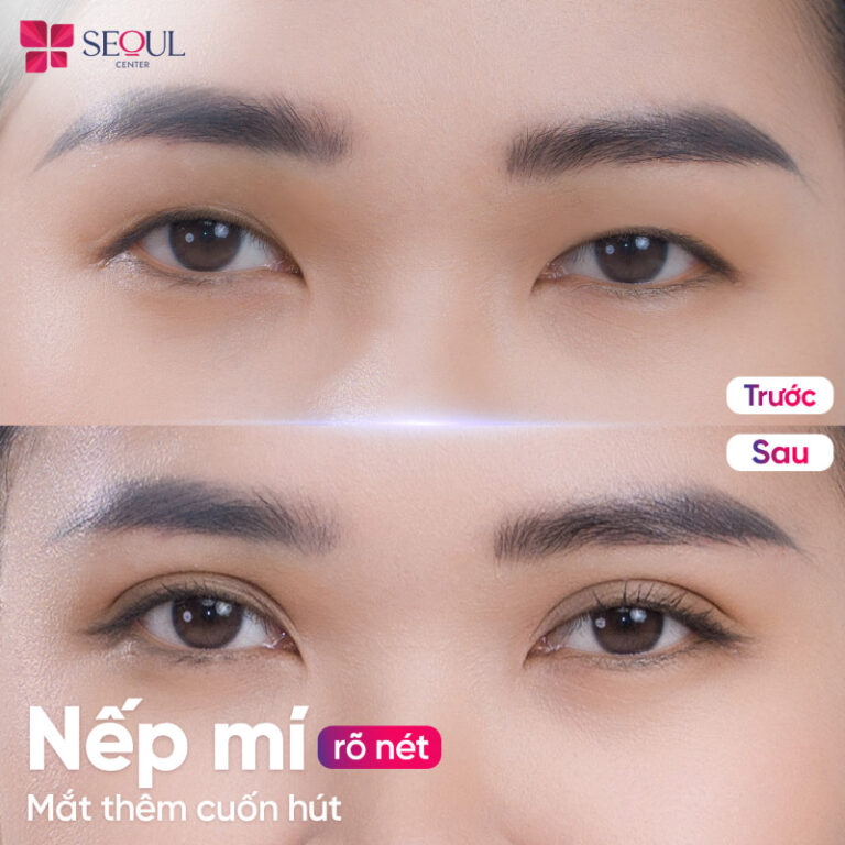 Đôi mắt được khắc phục khuyết điểm mí lót hiệu quả