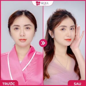 Đường mí tự nhiên, hài hòa với vẻ đẹp của gương mặt