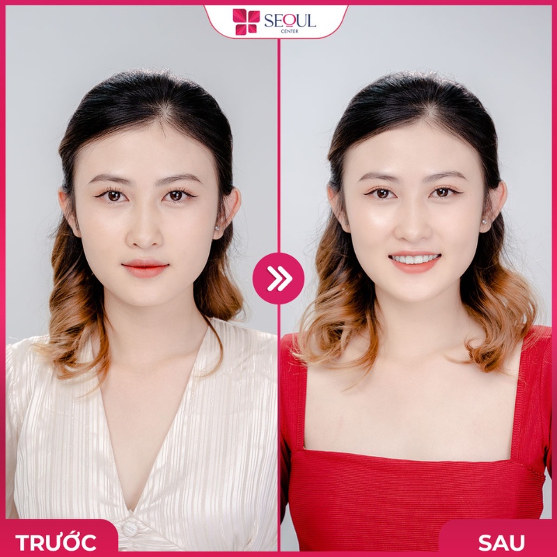 Nhược điểm mắt nhỏ, mí mắt sụp được khắc phục triệt để