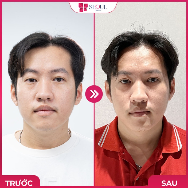 Mí mắt đẹp, ấn tượng sau khi thực hiện tiểu phẫu