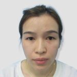 Trước cắt mí không nên dùng chất kích thích hay aspirin