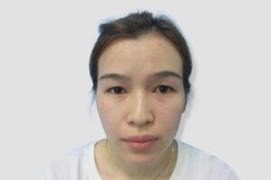 Trước cắt mí không nên dùng chất kích thích hay aspirin