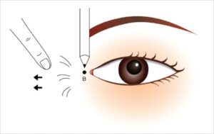Mở rộng góc mắt trong là phẫu thuật và điều chỉnh khoé mắt to hơn