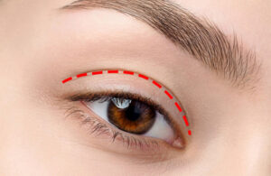 Nhấn mí vi sợi tạo mắt 2 mí tự nhiên