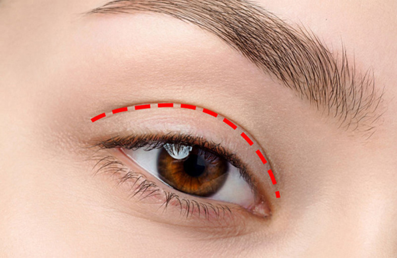   Nhấn mí vi sợi tạo mắt 2 mí tự nhiên