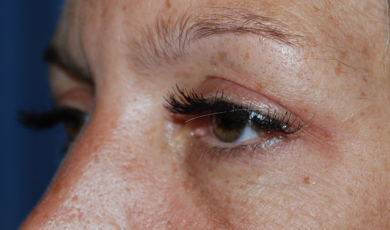   Vết mổ sau khi cắt mí chỉ cần khoảng 2 tuần để phục hồi