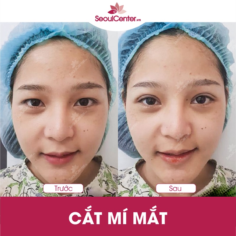   Mất khoảng 6 tháng để mí mắt đạt được trạng thái hoàn hảo nhất