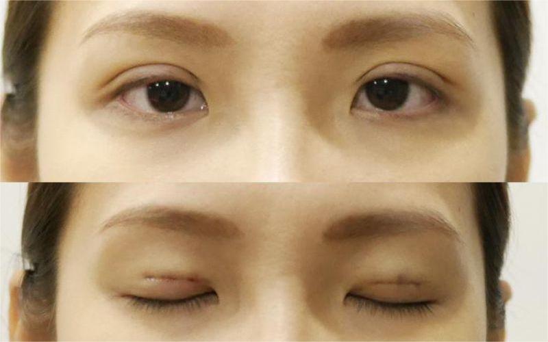 Nhấn mí luồn chỉ là phương pháp đảm bảo an toàn tuyệt đối khi sử dụng Nhấn mí luồn chỉ là phương pháp đảm bảo an toàn tuyệt đối khi sử dụng
