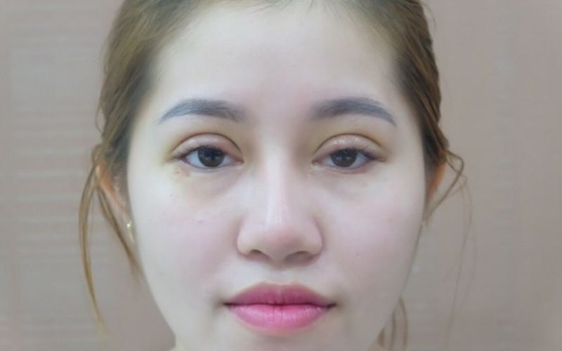 Cắt mí mắt sâu khiến 2 mí không đều
