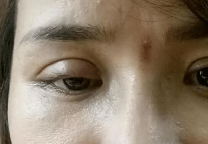 Cắt mí mắt bị sâu khiến cho đôi mắt bị trũng và lõm sâu