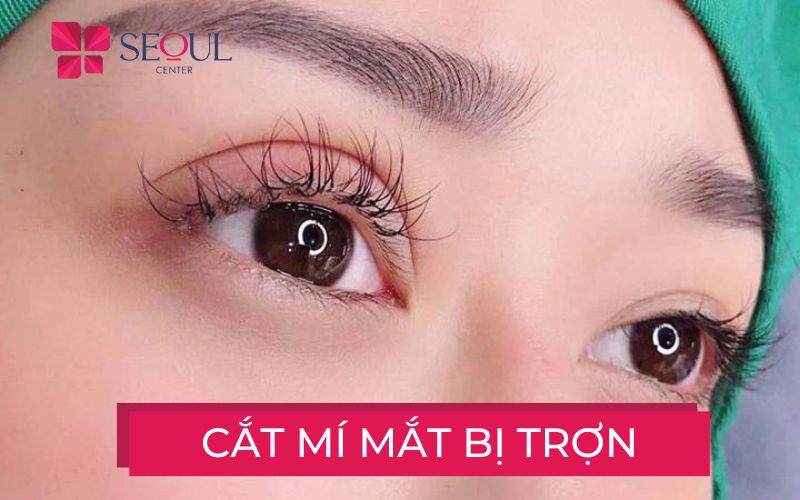 Mí mắt bị trợn ngược do cắt mí mắt bị sâu