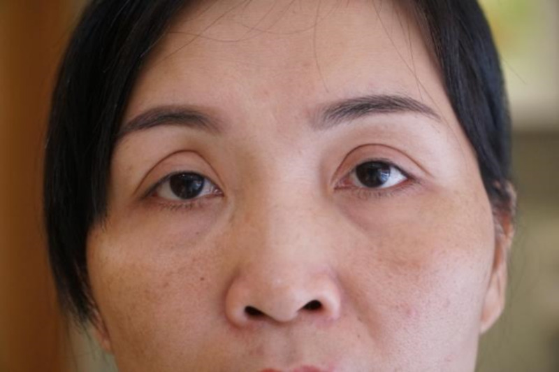 Cắt mí mắt bị sâu do bác sĩ tay nghề kém, kỹ thuật chưa chuẩn xác