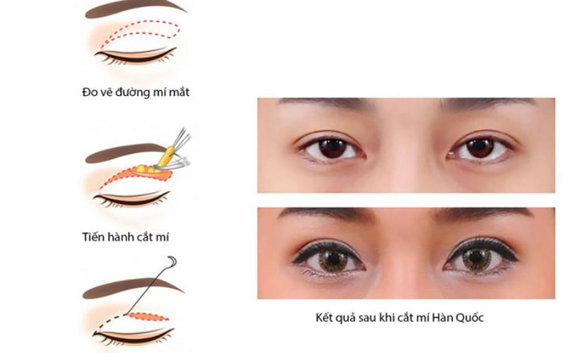 Cắt mí Perfect cần tiến hành xử lý đồng thời khuyết điểm mí trên và mí dưới