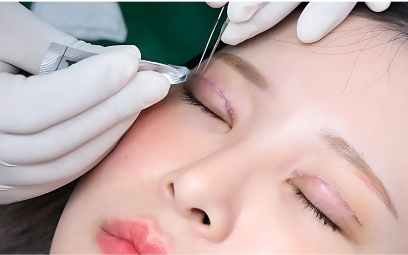 Nhấn mí bằng cách luồn chỉ liên kết da mí và cơ nâng mí là giải pháp hiệu quả, hạn chế xâm lấn Nhấn mí bằng cách luồn chỉ liên kết da mí và cơ nâng mí là giải pháp hiệu quả, hạn chế xâm lấn