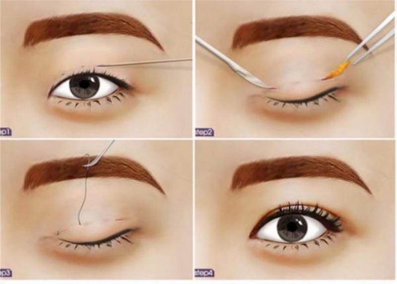 Nhấn mí luồn chỉ có thể duy trì được 10 – 11 năm nhưng không thể vĩnh viễn