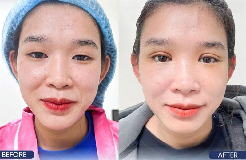 Nhấn mí luồn chỉ là gì? Nhấn mí luồn chỉ là gì?