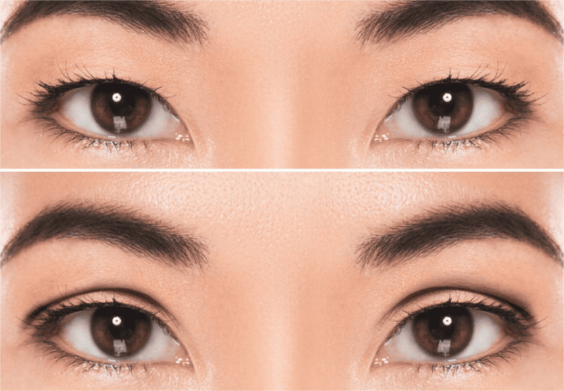 Cắt mí Eyelid vừa sở hữu nét đẹp tự nhiên, vừa hạn chế được tối đa các biến chứng