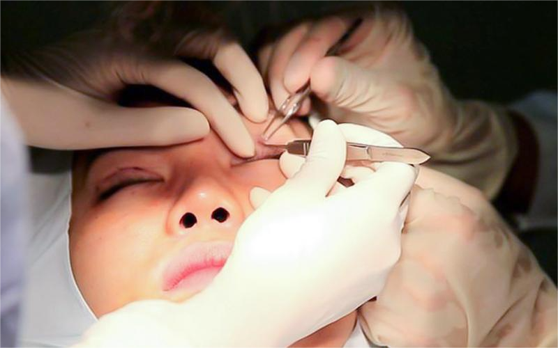 Quy trình nhấn mí chuẩn y khoa an toàn Quy trình nhấn mí chuẩn y khoa an toàn