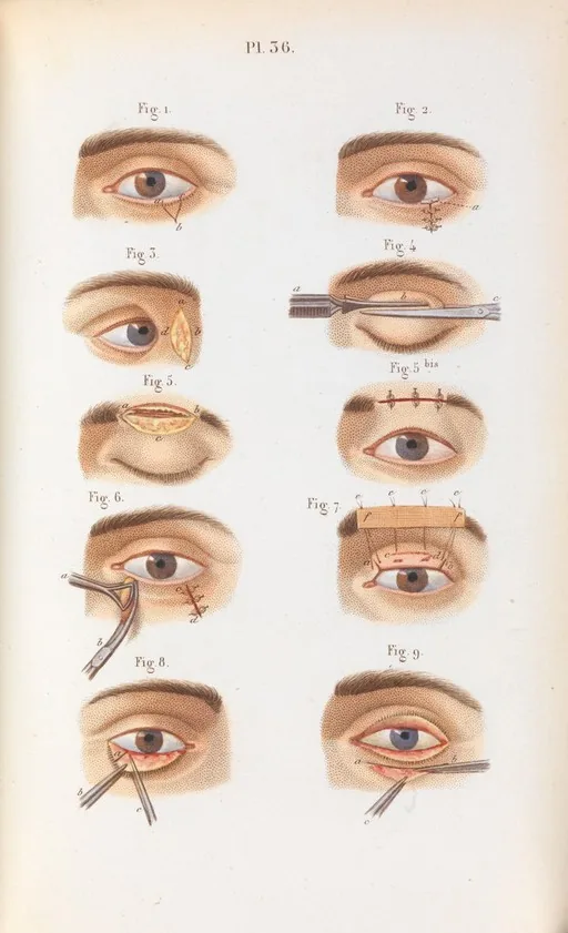 lower eyelid surgery