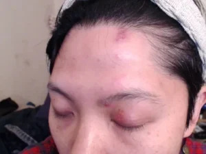 eyelid inflammation after blepharoplasty