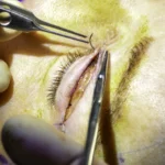 blepharoplasty techniques modern eyelid surgery methods
