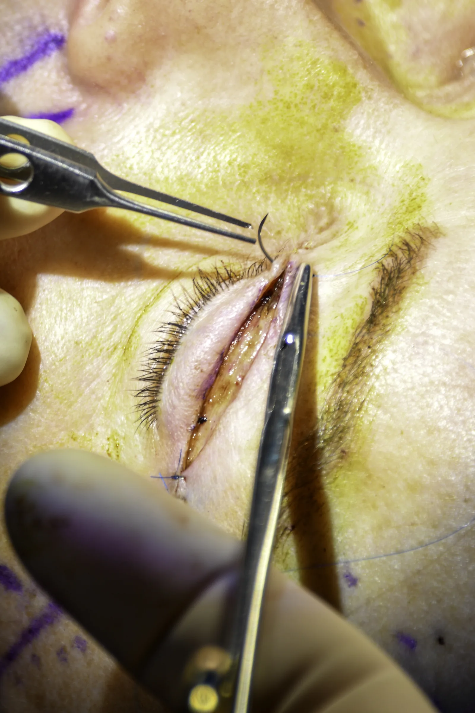 blepharoplasty techniques modern eyelid surgery methods