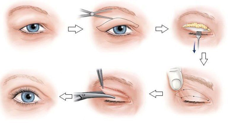 Khi vết cắt mí mắt đã lành thì mới có thể cắt chỉ
