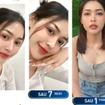 Cần có phương pháp chăm sóc đúng cách để hạn chế biến chứng sau cắt mí