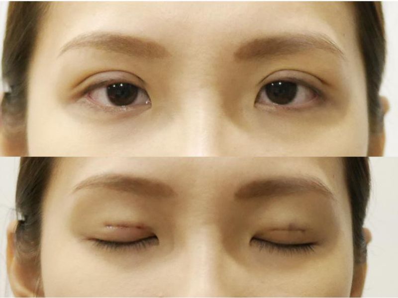 Vệ sinh bằng nước muối sinh lý để tránh tình trạng nhiễm trùng