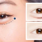Sau cắt mí cần thời gian để hồi phục và vào form
