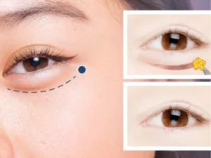Sau cắt mí cần thời gian để hồi phục và vào form