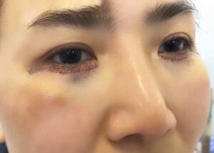 Cắt mí mắt dưới có bị thâm không phụ thuộc vào nhiều yếu tố