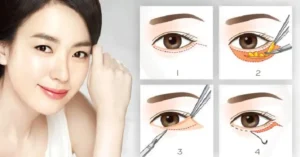 Phẫu thuật cắt mí mắt dưới thường phù hợp với một số đối tượng nhất định