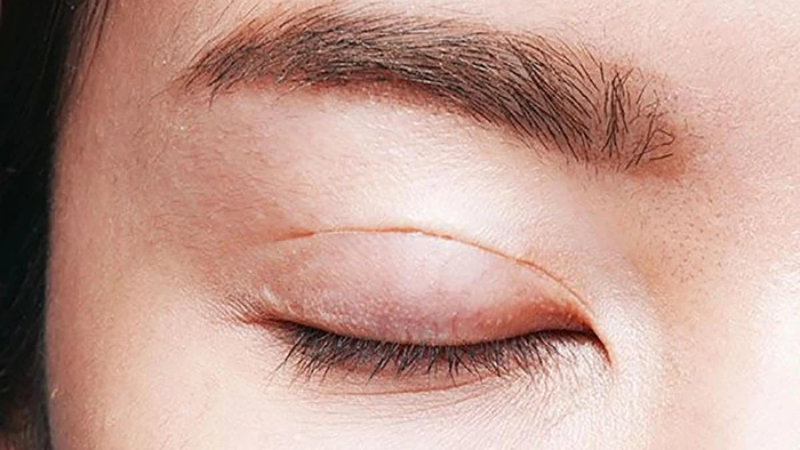 Sau cắt mí vẫn có thể thực hiện nhấn mí nếu chưa ưng ý