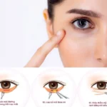 Cắt mí dưới giúp tăng tính thẩm mỹ, giúp chị em tự tin hơn về đôi mắt