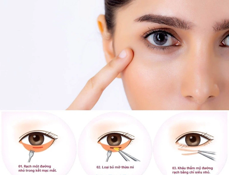 Cắt mí dưới giúp tăng tính thẩm mỹ, giúp chị em tự tin hơn về đôi mắt