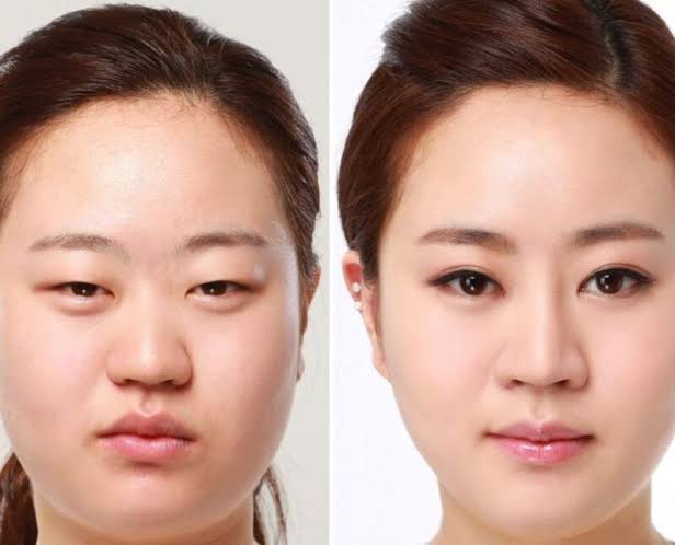 Trong một số trường hợp, bác sĩ sẽ cho lời khuyên không nên cắt mí quá sớm