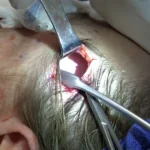 eyelid lift recovery
