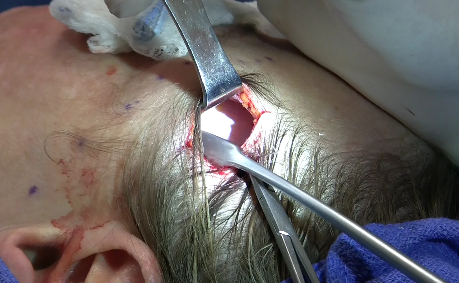 eyelid lift recovery