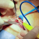 lower blepharoplasty dark circles removal