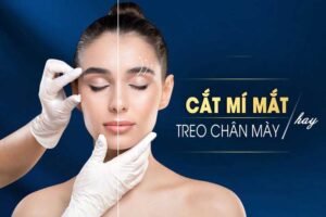 Tùy vào trình trạng mí mắt mà bạn có thể lựa chọn cắt mí hoặc nâng cung chân mày